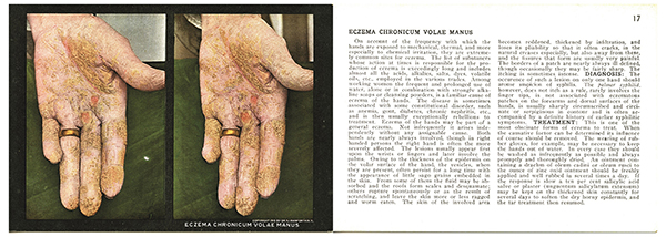 Front and back of the stereoscope card labeled “Eczema Chronicum Volae Manus” from The Stereoscopic Skin Clinic published by Dr. [Seldon Irwin] Rainforth in 1910 